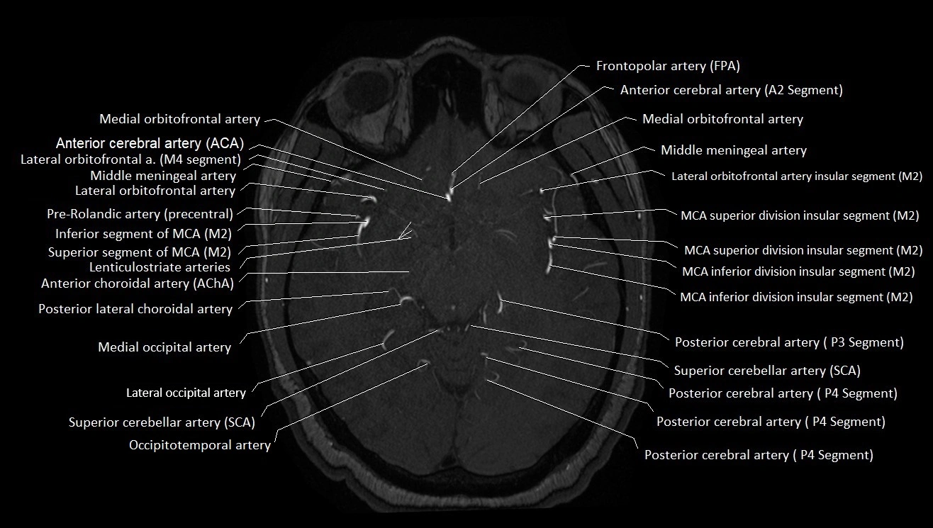 MRA brain (cerebral arteries) anatomy axial 3T image 20.webp